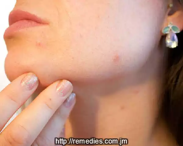Acne Remedies